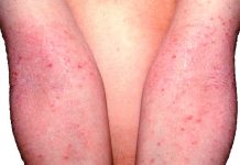 Dermatitis atópica padecerla genera pensamientos suicidas dermatitis atopica