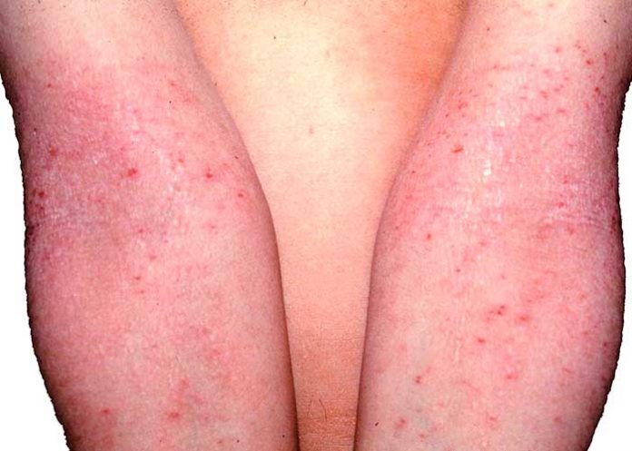 dermatitis atopica