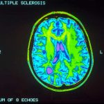 Flora intestinal serviría para reducir inflamación de la esclerosis celulas plasmaticas