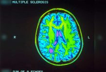 Flora intestinal serviría para reducir inflamación de la esclerosis celulas plasmaticas