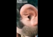 Mira el asqueroso insecto que le extrajeron del oído a un hombre en la India video