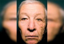 El caso McElligott: se le envejeció una parte del rostro rayos solares