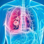 Automedicación cuando hay infecciones respiratorias puede terminar en neumonía neumonia