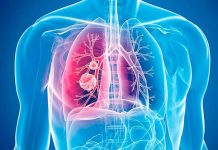 Automedicación cuando hay infecciones respiratorias puede terminar en neumonía neumonia