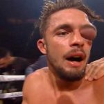 Golpe le deja el ojo del tamaño de una pelota de béisbol (Video) video