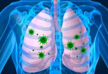 Las graves complicaciones que puede dejar la influenza AH1N1 neumonia