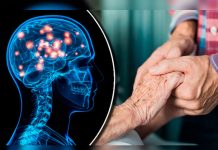 Descubren test de diagnóstico inmediato para mal de Huntington enfermedades hereditarias