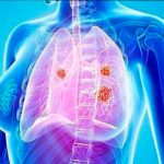 La cifra de mortalidad por cáncer de pulmón en mujeres es alarmante cancer de pulmon