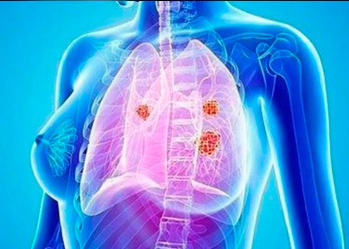 cancer de pulmon