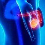 Cáncer testicular, ¿qué hombres son propensos a sufrirlo? cancer de testiculos