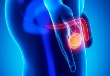 Cáncer testicular, ¿qué hombres son propensos a sufrirlo? cancer de testiculos