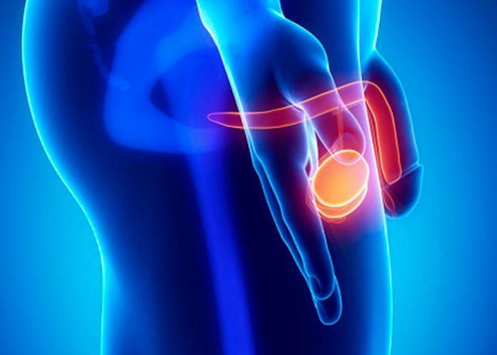 cancer de testiculos