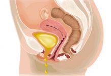 Asocian a la obesidad el riesgo de padecer incontinencia urinaria uretra