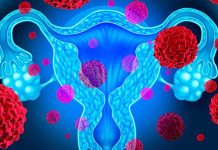 Estos tipos de cáncer suelen confundirse con otras afecciones cancer