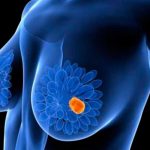 Un trazador fluorescente esencial en la detección del cáncer de mama cancer de mama