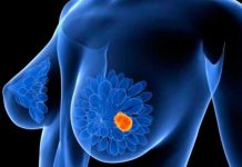 Un trazador fluorescente esencial en la detección del cáncer de mama cancer de mama