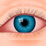 Síndrome de ojo seco, podría afectarte sin que lo sepas ojo seco