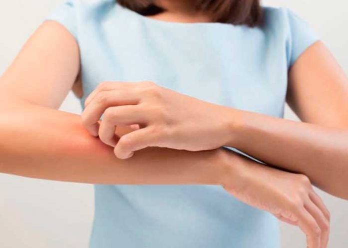 portada_zoB7ADl reacciones alergicas