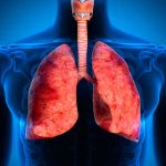 acumulacion de liquido en pulmones