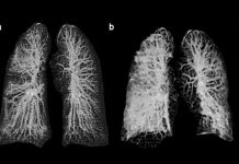 Así se ven los pulmones dañados de los primeros pacientes en Italia con coronavirus coronavirus