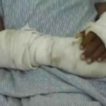 Bolivia: Mujer quema los brazos de su hija por robar dulces en una tienda bolivia