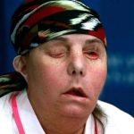 Mujer recibe un segundo trasplante de cara en EE.UU. estados unidos