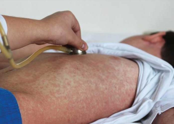 samoa-sarampion-_z3t0e8v