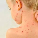 Se reportan casi 230 casos de sarampión este 2019 en EEUU america del norte