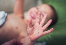Desconfianza de las vacunas desata un brote de sarampión en Ucrania