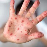 EE.UU.: Universidades en cuarentena por contagio de sarampión estados unidos