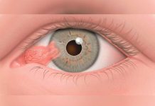Desarrollan biofármaco para curar enfermedad ocular pterigión