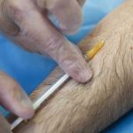 109 enfermos por un brote de tuberculosis en Alemania alemania