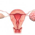 Tipos y síntomas de cáncer que sólo se presentan en mujeres tipos