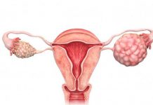 Tipos y síntomas de cáncer que sólo se presentan en mujeres tipos
