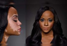 Una mujer afirma haber revertido el vitiligo de esta curiosa forma salud