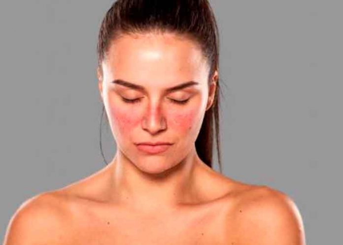 2 salud, lupus, dia mundial, sintomas, causas