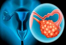 Cáncer de ovario: ¿Qué es, síntomas y causas?