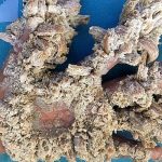 Operado a palestino con la rara enfermedad del «hombre árbol»