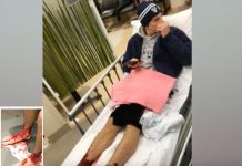 Piojos de mar devoran piernas de jovencito (VIDEO)