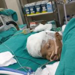 Separan a dos siameses unidos por la cabeza