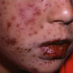 Alerta por «Coxsackie» brote en la piel que afecta a niñez de Costa Rica