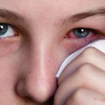 Reportan 14 mil casos de conjuntivitis en Honduras