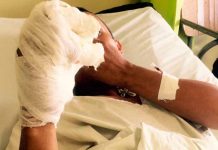 Honduras: Hombre pierde tres dedos tras explotarle un mortero en la mano