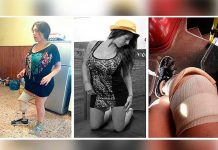 Argentina: Joven se hizo liposucción y terminó sin una pierna