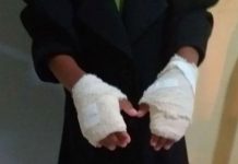 Brasil: Quemó las manos de su nieta en castigo por «mal comportamiento»