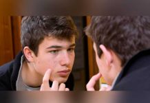 ¿Por qué sale acné en ciertas partes del cuerpo? Descúbrelo aquí