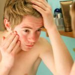 Descubren la auténtica causa del acné