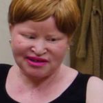 Brujos cortaron brazos a albina para hacer «poción mágica»