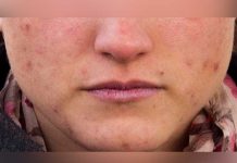 Mira cómo tratar las cicatrices del acné acne