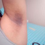 ¿Axilas oscuras y manchadas? Con esta pomada puedes aclararlas